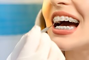 Orthodontiste Hull – Braces & Invisalign for All Ages